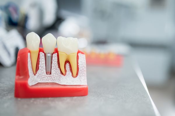 Aftercare Instructions From An Implant Dentist